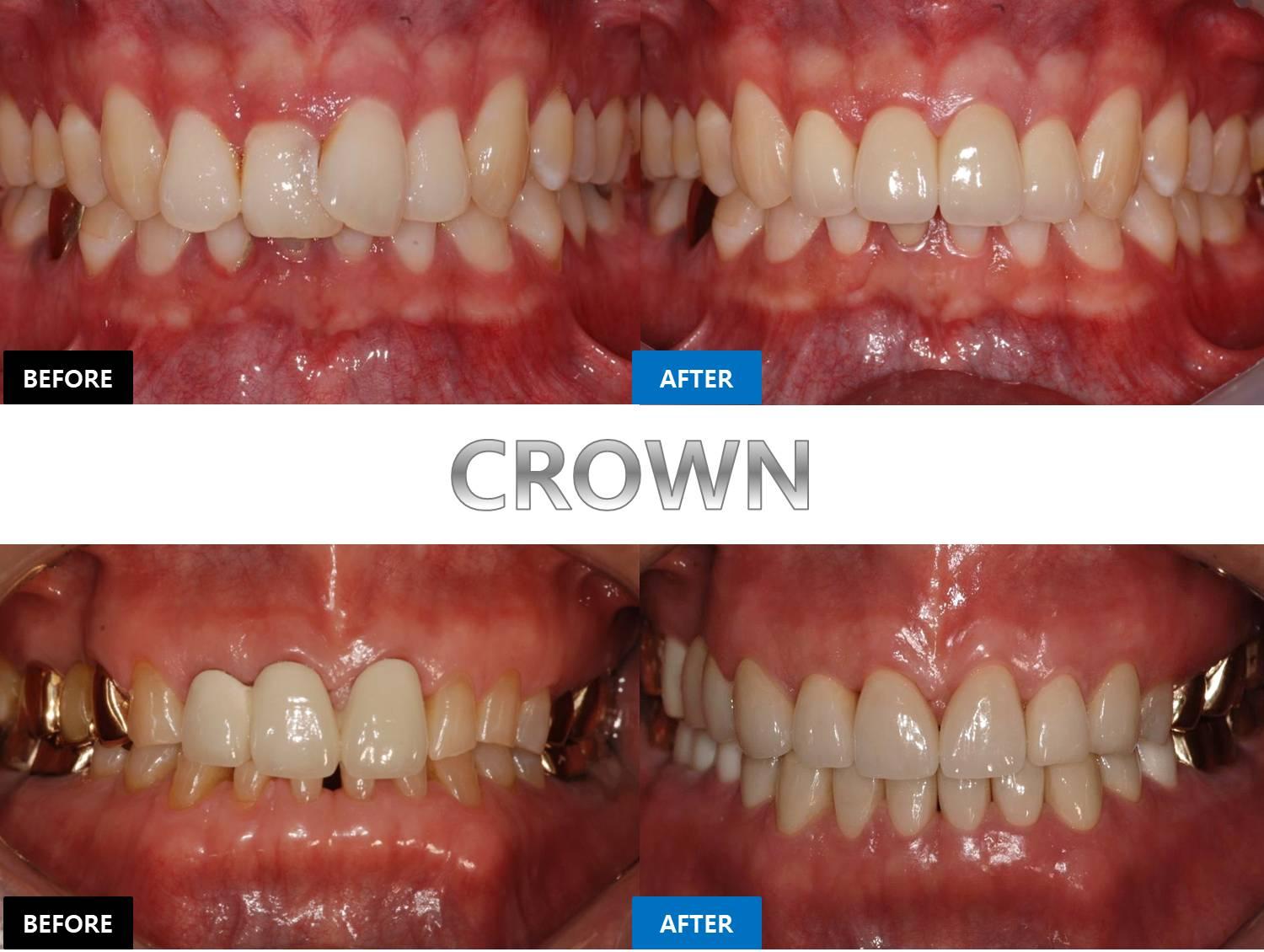Before-and-after close-up of a patient's upper and lower teeth showing dental crown restorations and improved alignment.