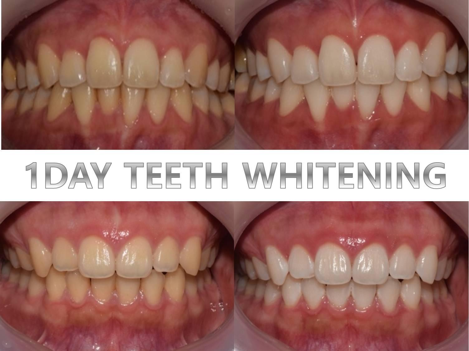 Four close-up before-and-after intraoral photos showing significant tooth shade improvement after GOODWILL 1DAY TEETH WHITENING.