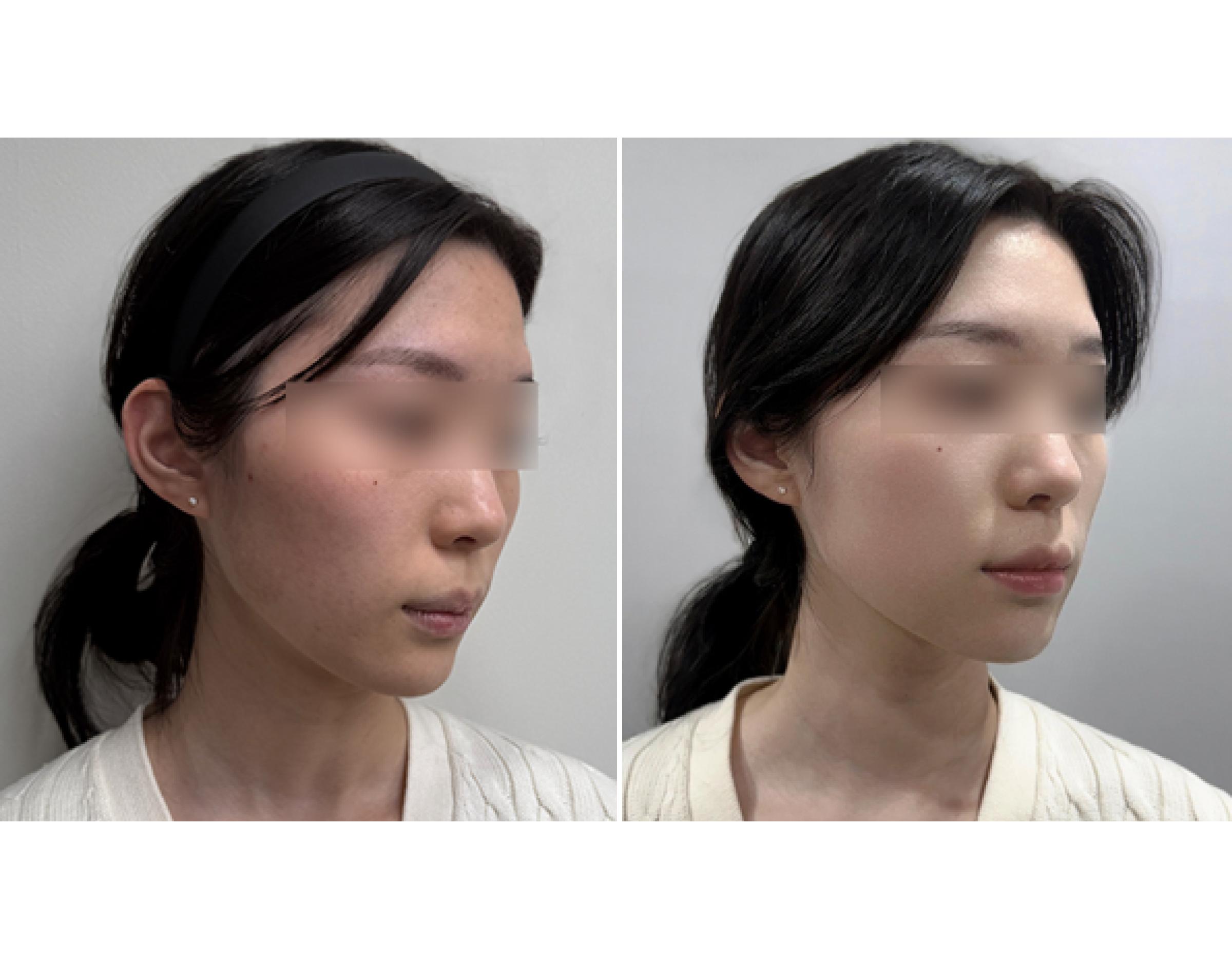 side-by-side before-and-after photos of a woman's left profile and neck with hair tied back and face blurred, wearing a light sweater