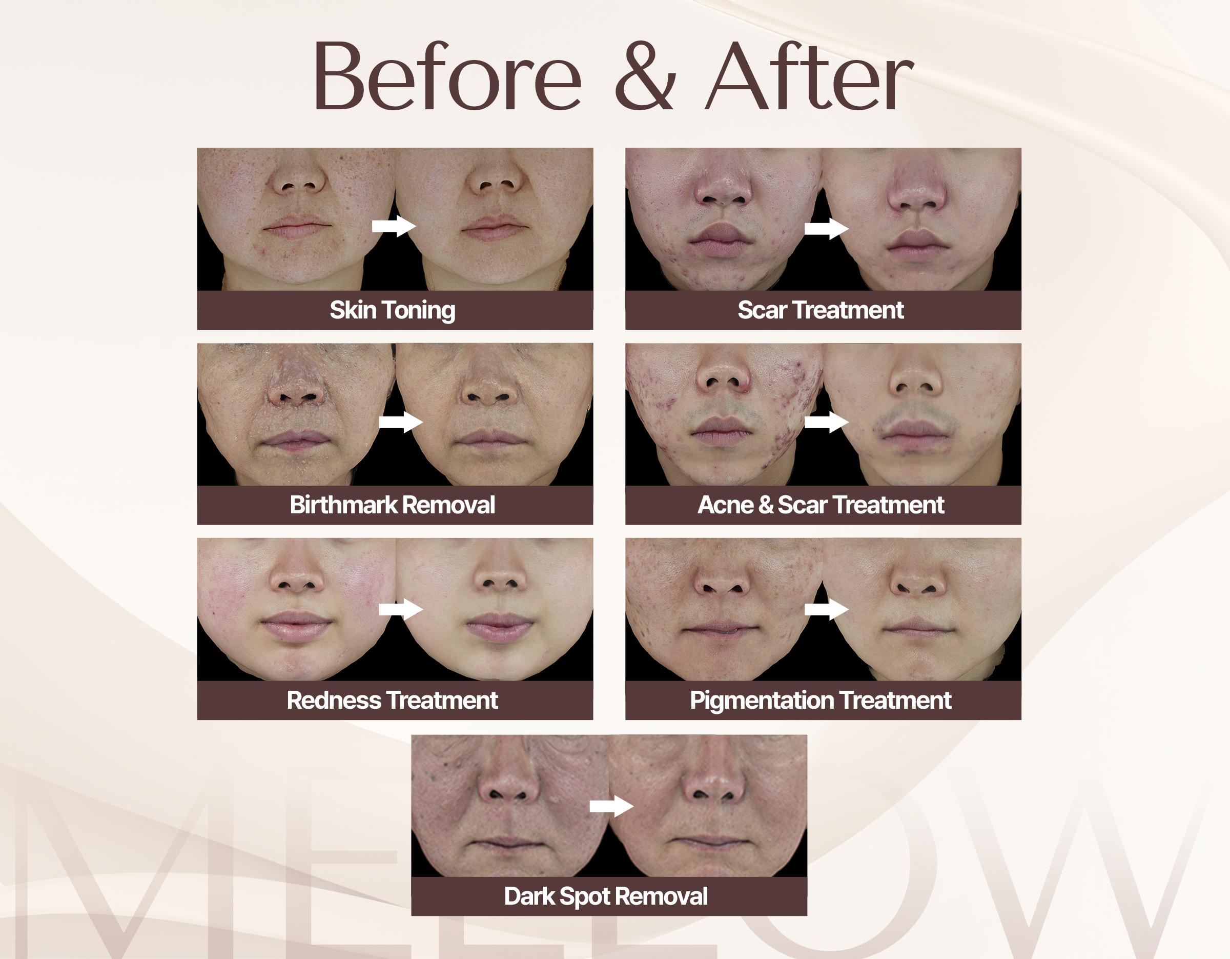 MELLOW CLINIC Cheongdam | Board-Certified Skin Clinic in Gangnam 5