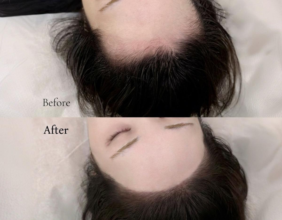 Before-and-after top-down view of hairline restoration showing sparse frontal hair filled in with natural-looking strokes.