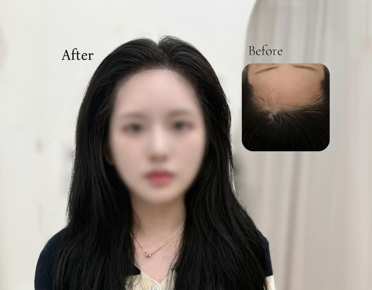 after-and-before collage showing a woman with long dark hair and a refined natural hairline, inset before photo of sparse hair at forehead