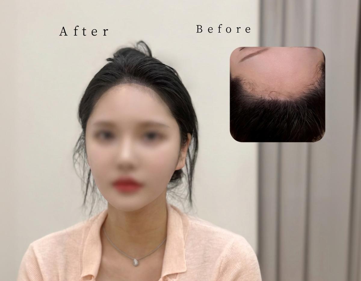 frontal view of a woman with blurred face showing darker, lowered hairline after hairline design; inset top-right close-up before treatment.