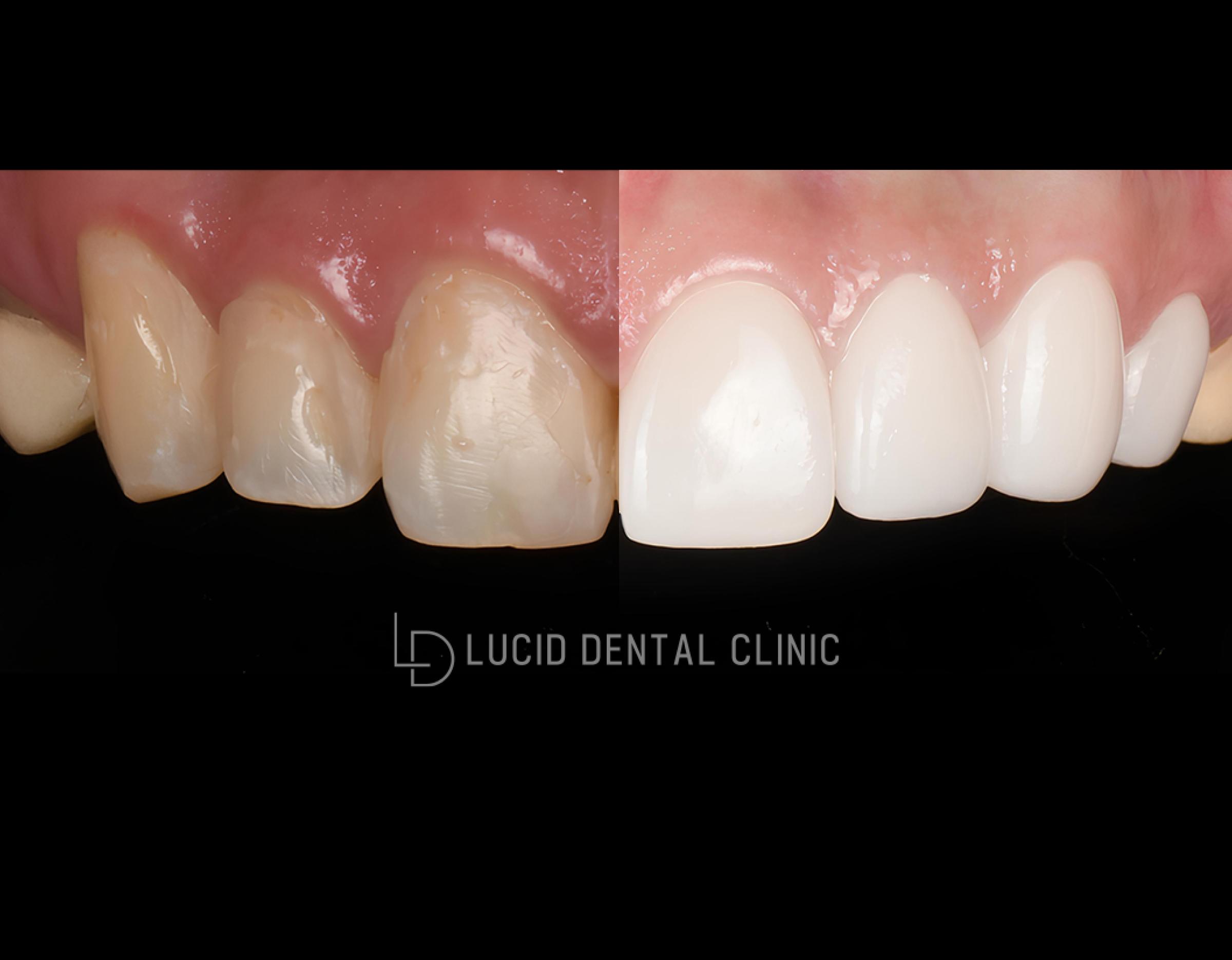 Split before-and-after close-up of upper front teeth showing stained natural teeth left and bright veneered teeth right, Lucid Dental Clinic
