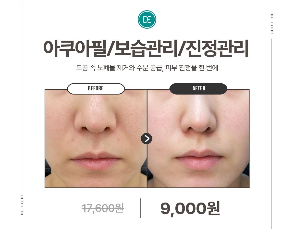 Dr. Evers Clinic Seomyeon before and after 2