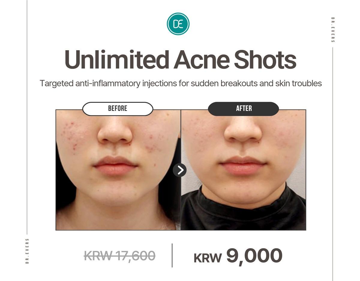 Dr. Evers Clinic Seomyeon before and after Unlimited Acne Shots
