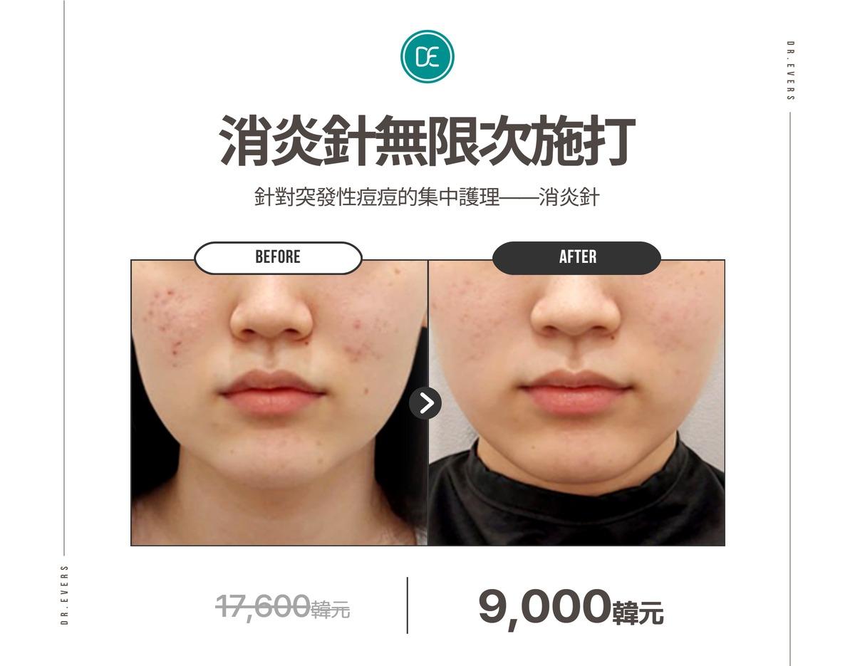 Dr. Evers Clinic Seomyeon before and after Unlimited Acne Shots