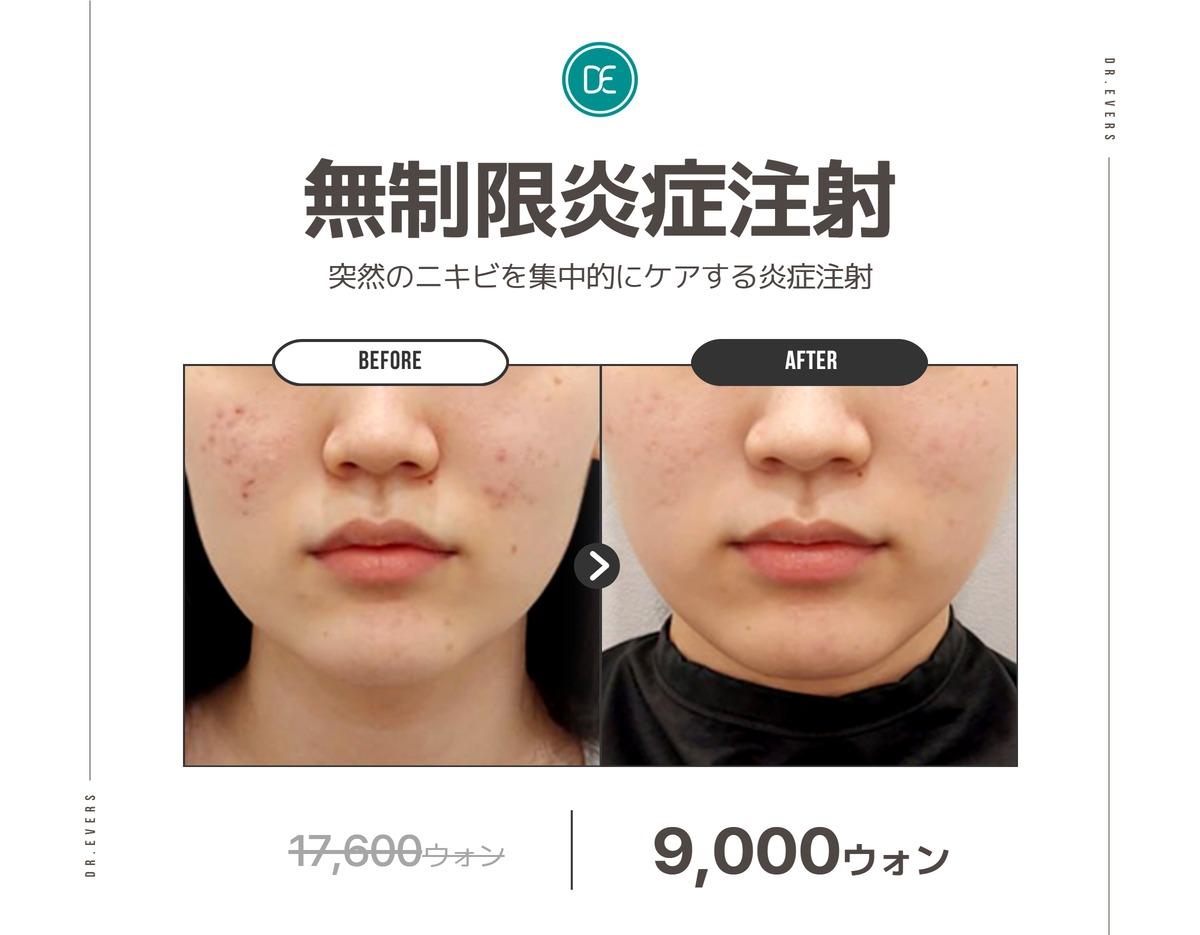 Dr. Evers Clinic Seomyeon before and after Unlimited Acne Shots