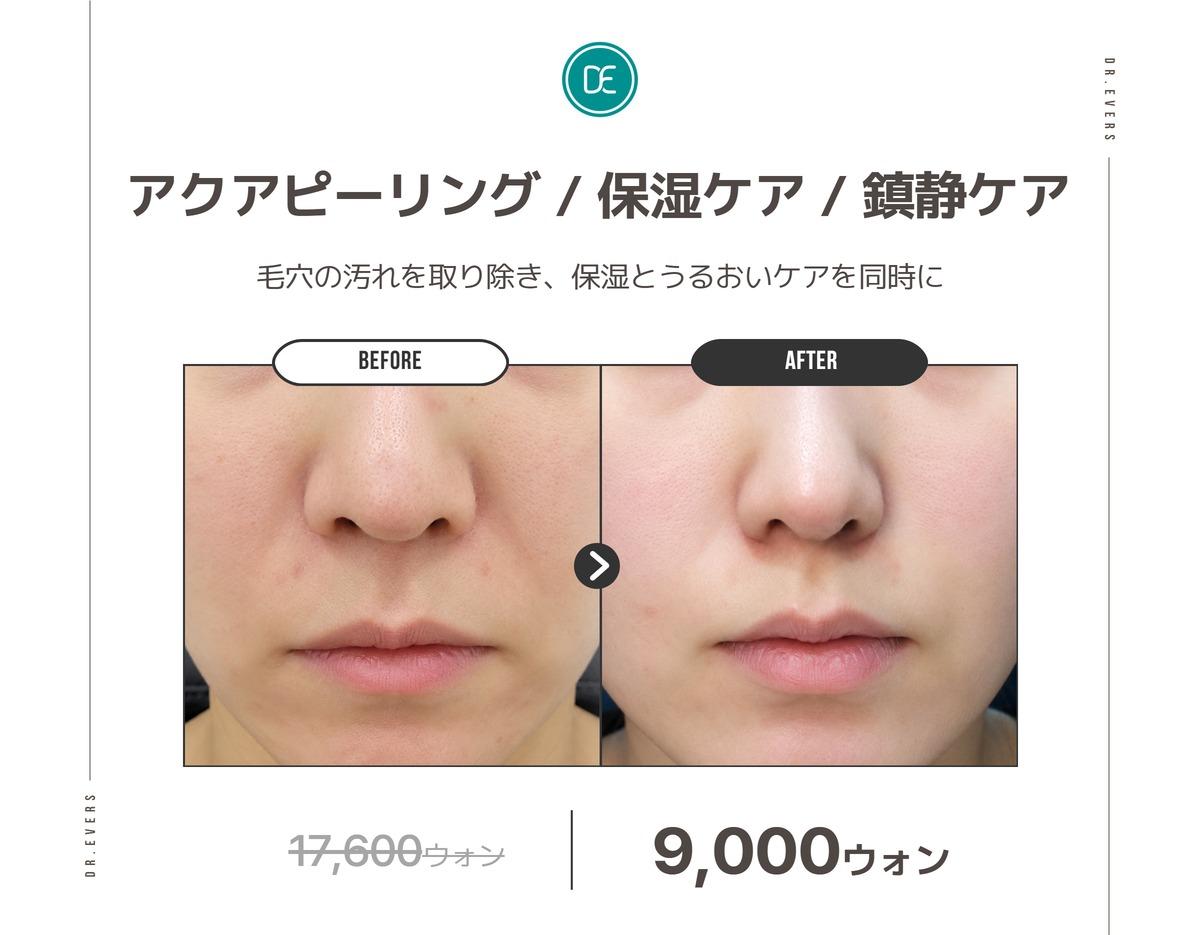 Dr. Evers Clinic Seomyeon before and after Aqua Peeling