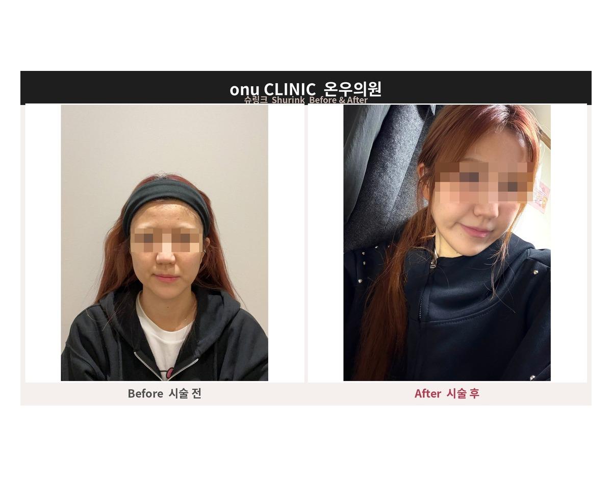 Onu Clinic Shurink before-and-after comparison photo