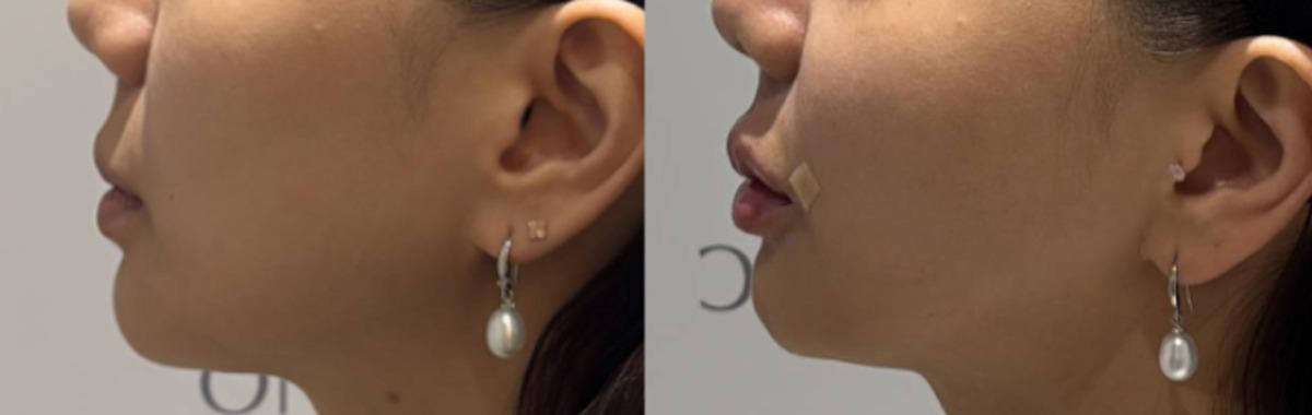 Onu Clinic lip Filler before-and-after comparison photo