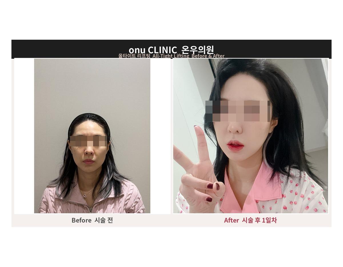 Onu Clinic AllTite Lifting before-and-after comparison photo