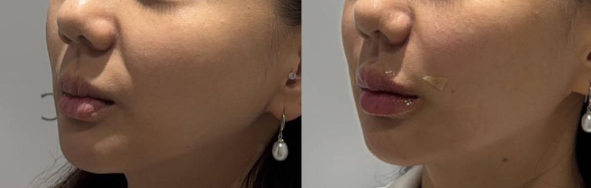 Onu Clinic lip Filler before-and-after comparison photo