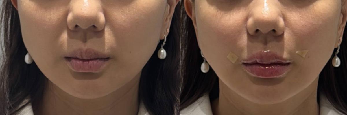 Onu Clinic lip Filler before-and-after comparison photo