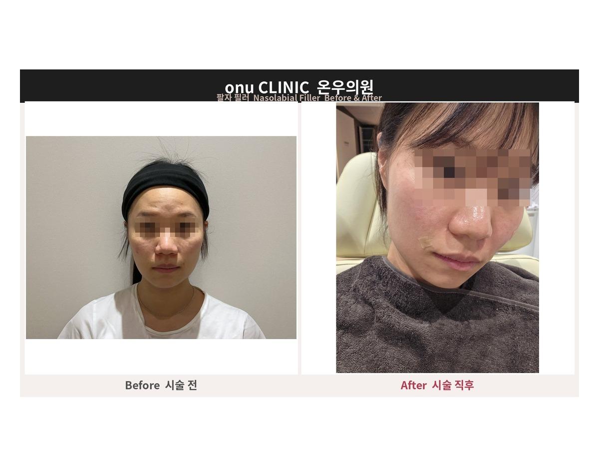 Onu Clinic nasolabial fold Filler before-and-after comparison photo