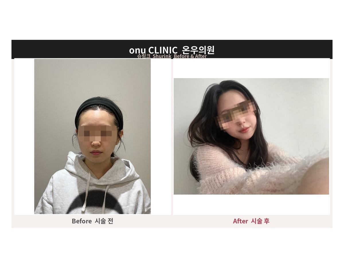 Onu Clinic Shurink before-and-after comparison photo
