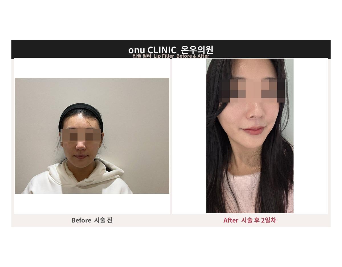 Onu Clinic lip Filler before-and-after comparison photo