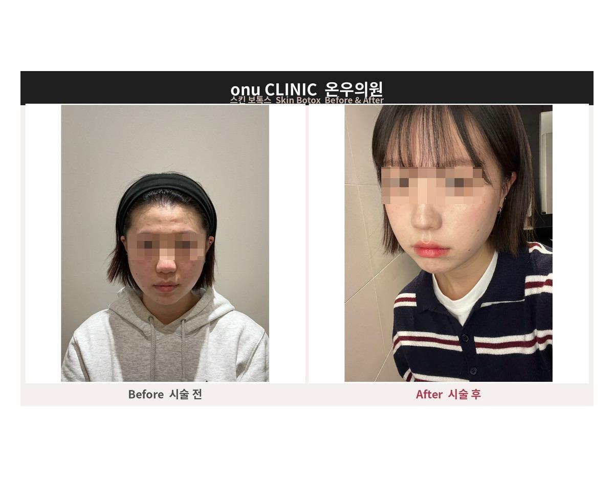Onu Clinic Skin Botox before-and-after comparison photo