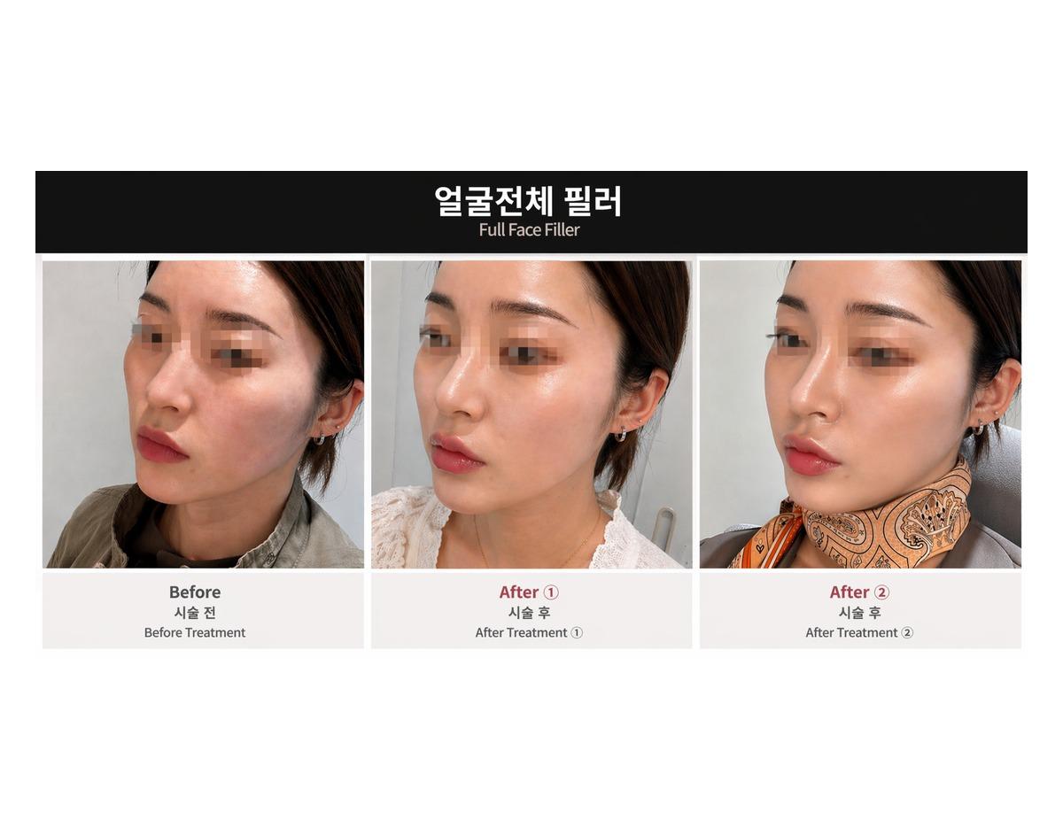 Onu Clinic full-face Filler before-and-after comparison photo