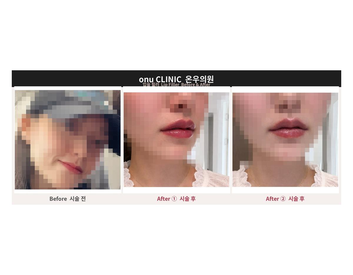 Onu Clinic lip Filler before-and-after comparison photo