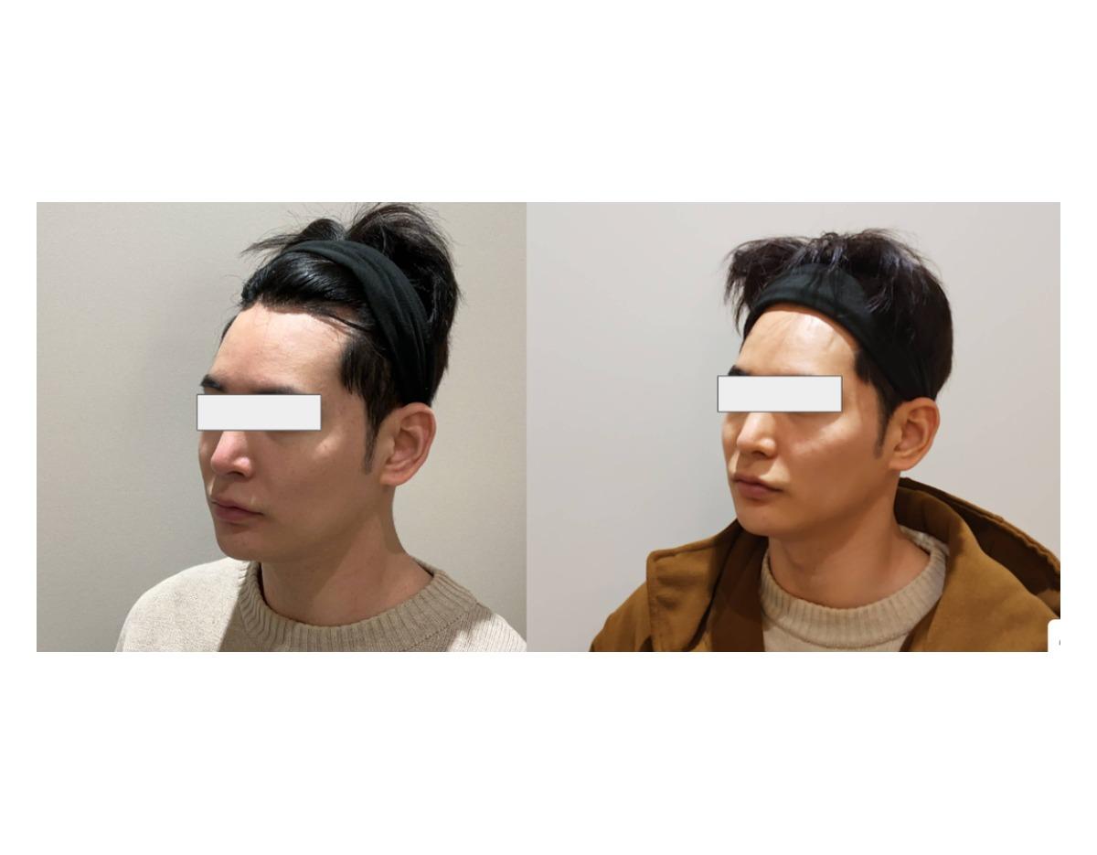 Onu Clinic Portra Quattro before-and-after comparison photo