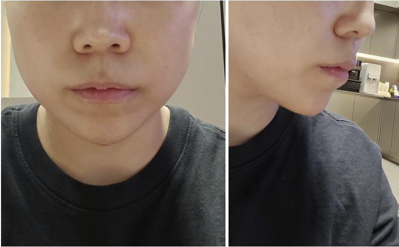 Chin Filler after photo