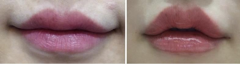 Lip Filler after photo 2