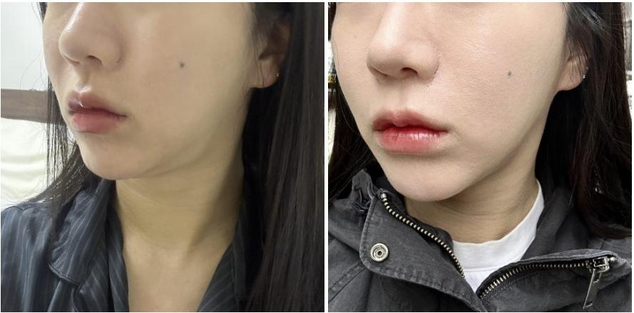 Titanium Lifting before and after photo 2