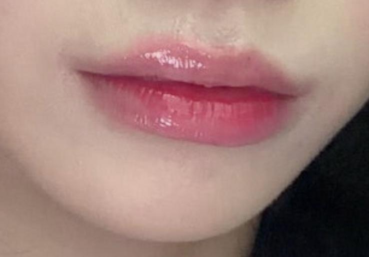 Lip Filler after photo