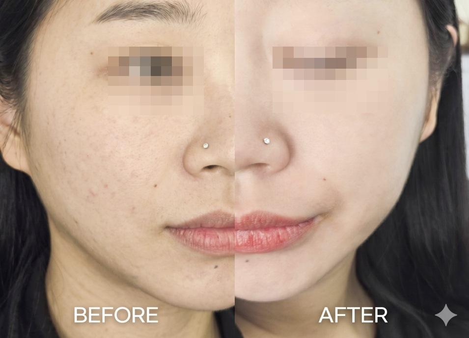 Juvelook Skin before and after photo