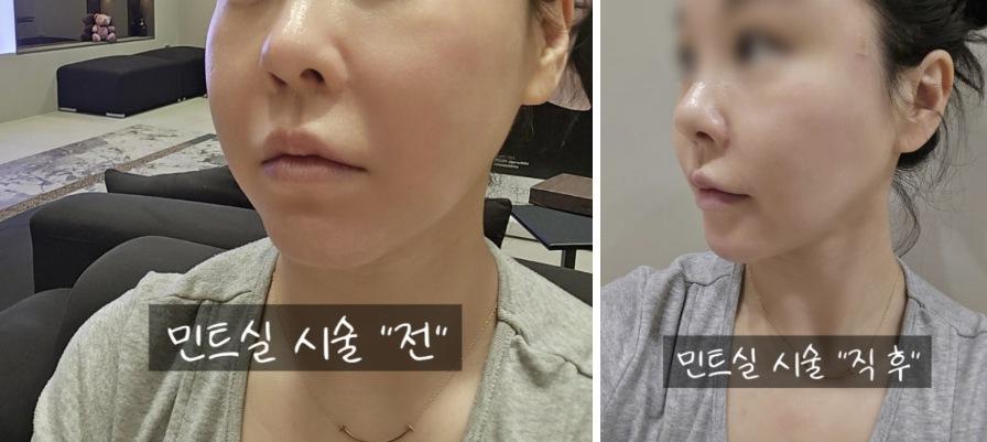 Mint Thread before and after photo 2