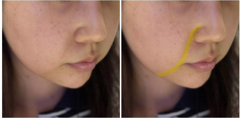Juvelook Volume nasolabial folds before photo