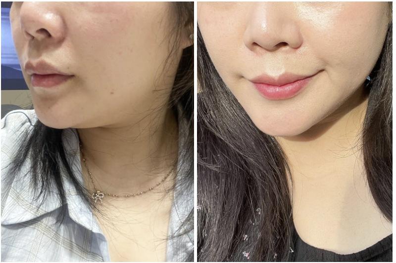 ONDA before and after photo 1