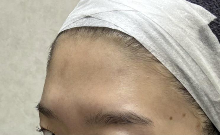 Forehead Filler before photo