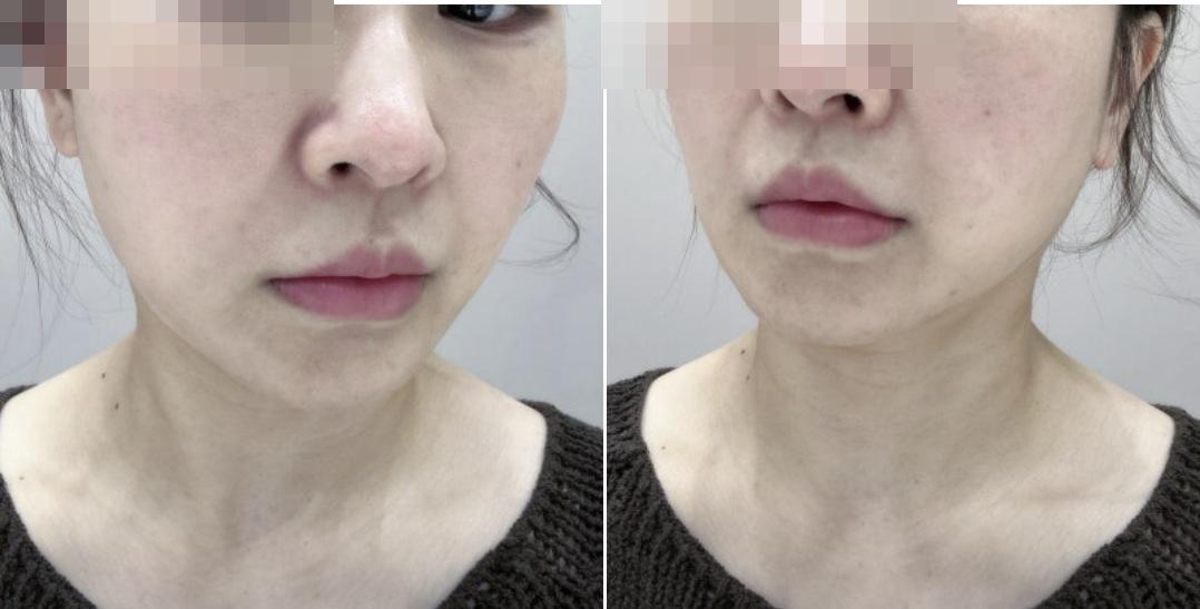 Potra before photo