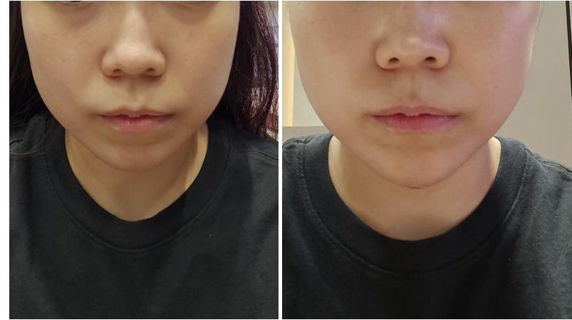 Chin Filler before and after photo