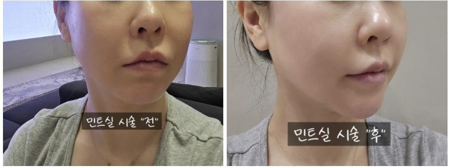 Mint Thread before and after photo 1