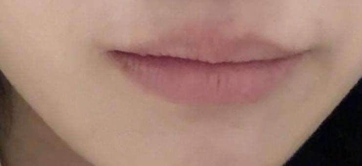 Lip Filler before photo