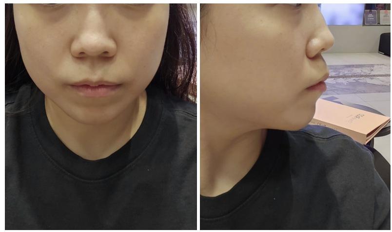 Chin Filler before photo