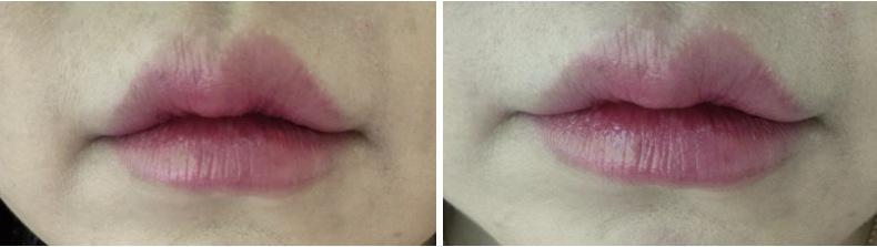Lip Filler before photo 2
