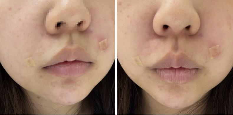 Juvelook Volume nasolabial folds after photo
