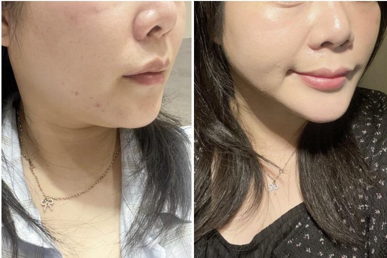ONDA before and after photo 2