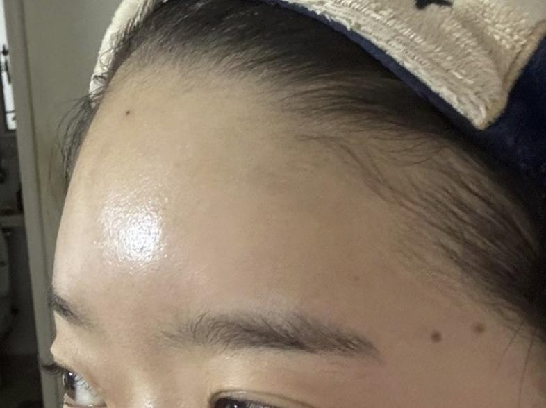 Forehead Filler after photo