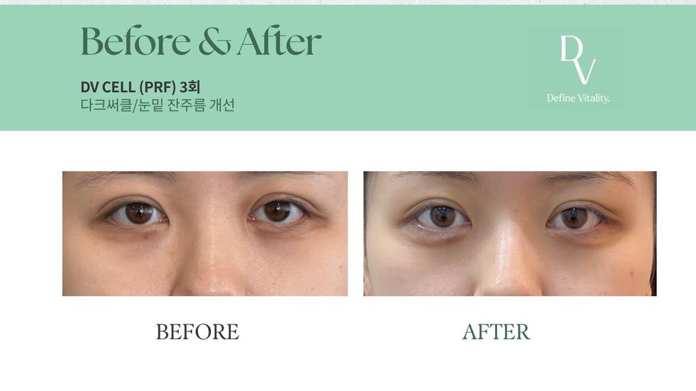 ダヴクリニック PRF 目の下 施術ビフォーアフター