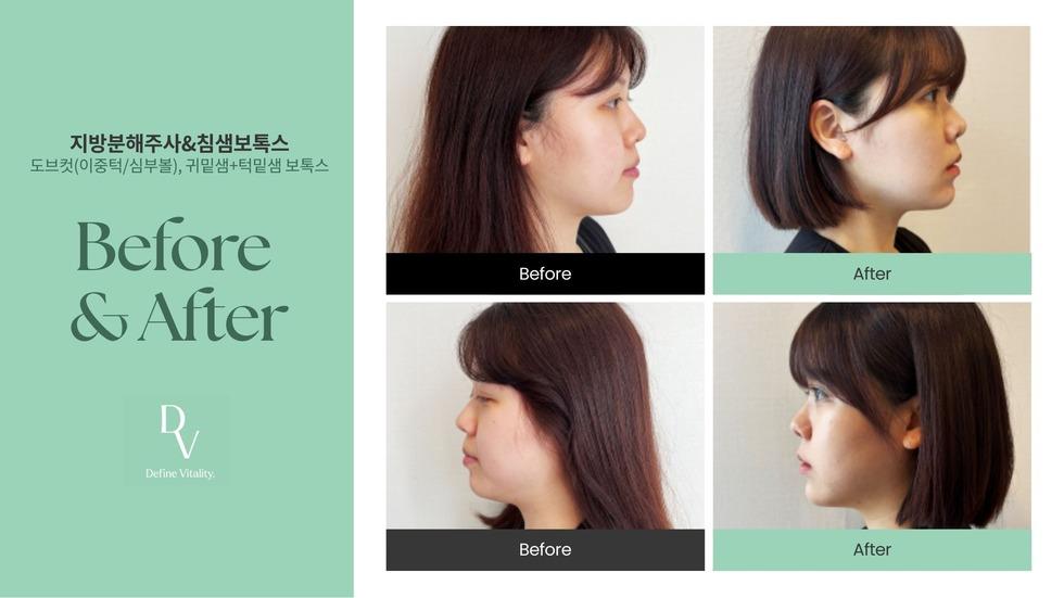 ダヴクリニック 脂肪分解注射&ボトックス 施術ビフォーアフター