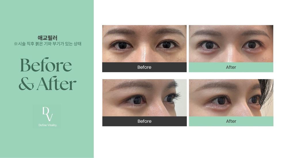 ダヴクリニック 涙袋フィラー 施術ビフォーアフター
