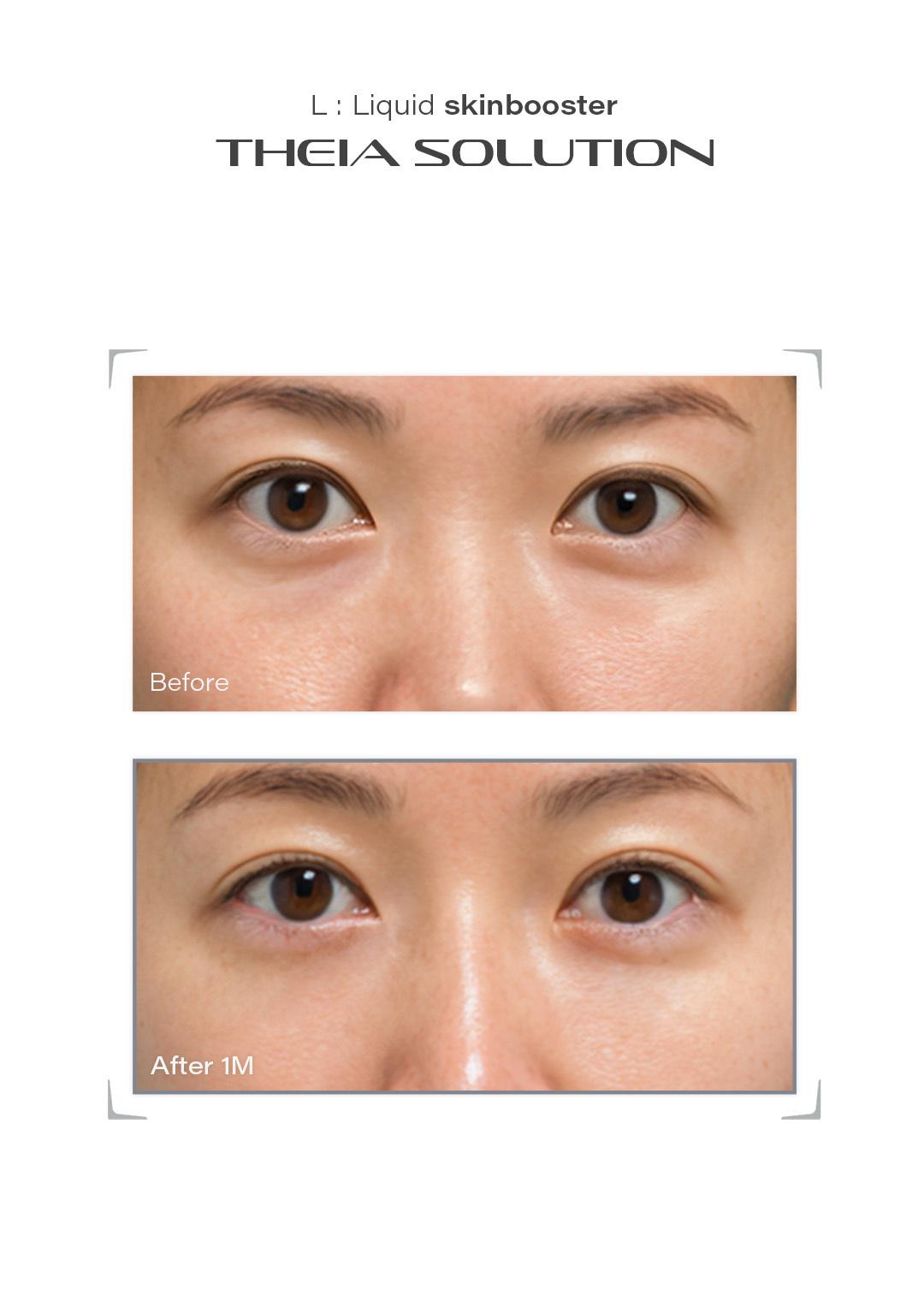 THEIA Solution before and after result example 15