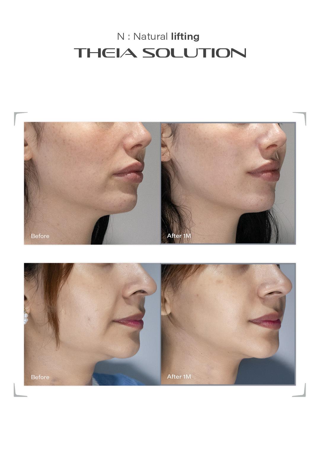 THEIA Solution before and after result example 11