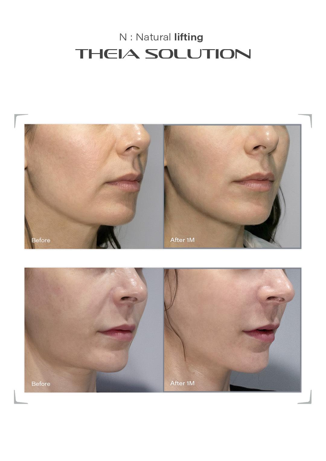 THEIA Solution before and after result example 1