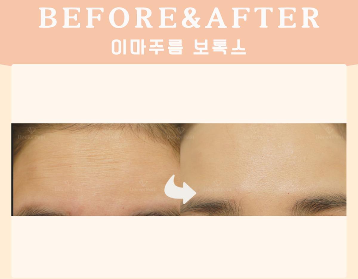 Before-and-after example